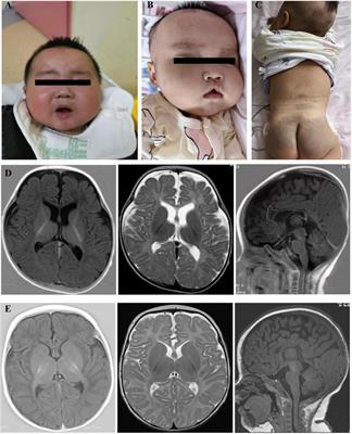 A case report of PGAP2-related hyperphosphatasia with impaired intellectual development syndrome in a Chinese family and literature review